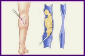 Склеротерапия - популярный способ избавиться от варикозного расширения вен на ногах. 